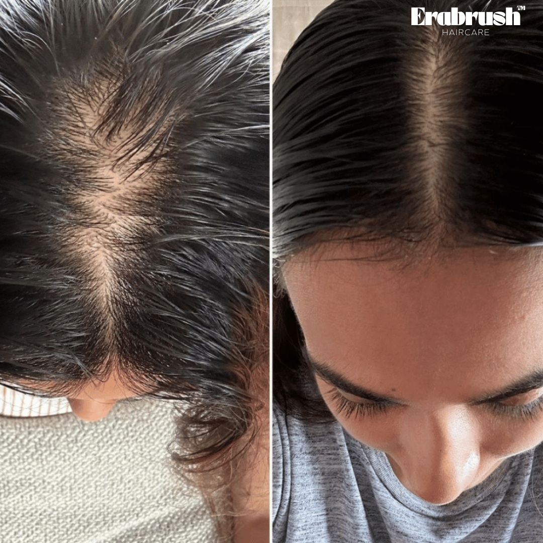 EraBrush™ + Hair Scalp Massager Brush for Hair Growth